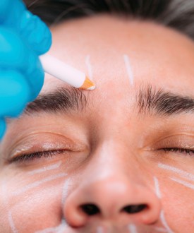 A close up photograph of a gloved hand making markings on a person's face in preparation for cosmetic surgery.